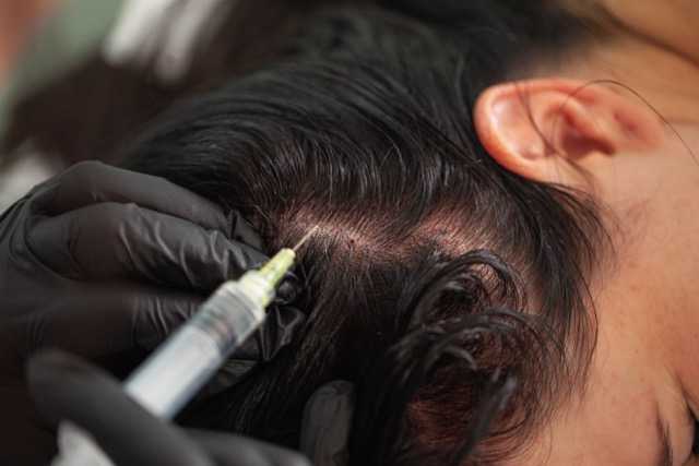 Mezoterapia igłowa skóry głowy